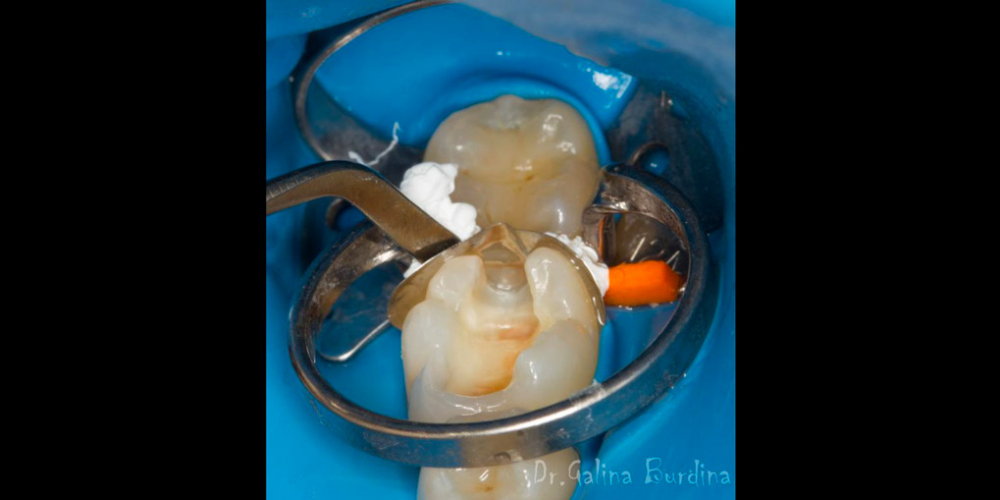 Лечение вторичного кариеса под пломбой, реставрация зуба 46, МОД - фото №6