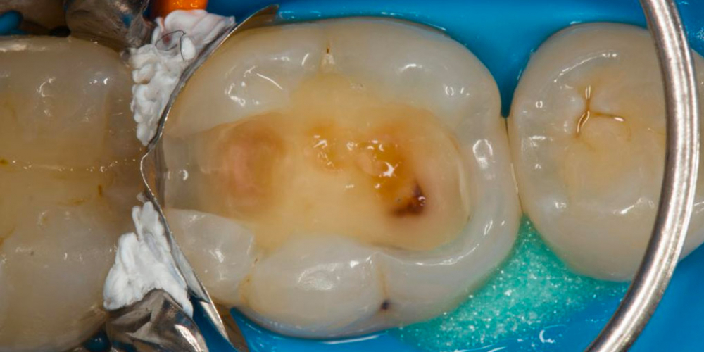 Лечение вторичного кариеса под пломбой, реставрация зуба 46, МОД - фото №7