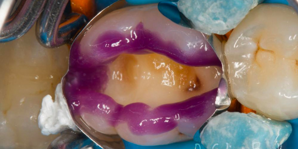 Лечение вторичного кариеса под пломбой, реставрация зуба 46, МОД - фото №9