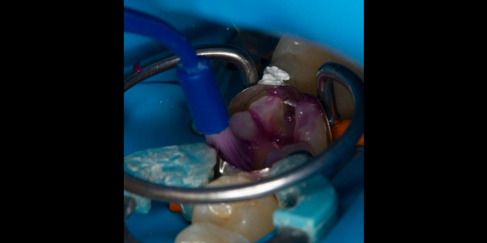 Лечение вторичного кариеса под пломбой, реставрация зуба 46, МОД - фото №10
