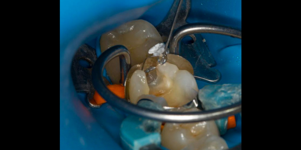 Лечение вторичного кариеса под пломбой, реставрация зуба 46, МОД - фото №11