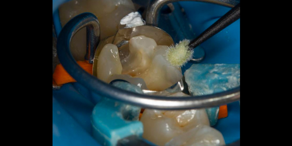 Лечение вторичного кариеса под пломбой, реставрация зуба 46, МОД - фото №12