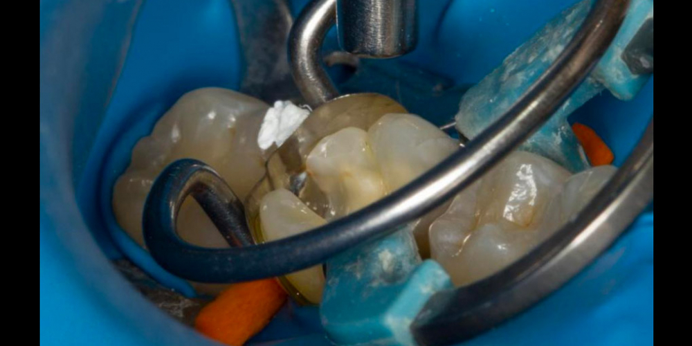 Лечение вторичного кариеса под пломбой, реставрация зуба 46, МОД - фото №13