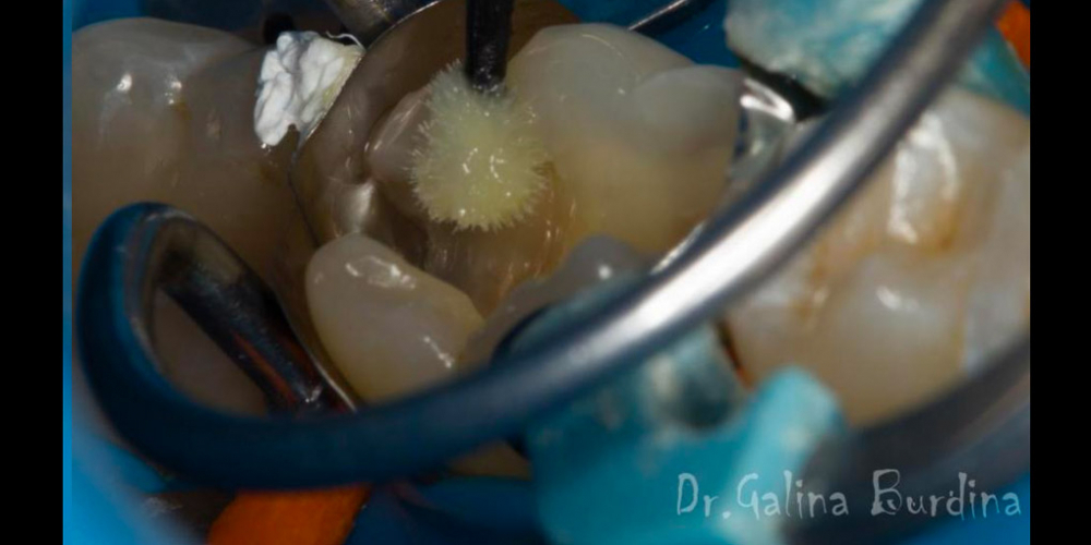 Лечение вторичного кариеса под пломбой, реставрация зуба 46, МОД - фото №14