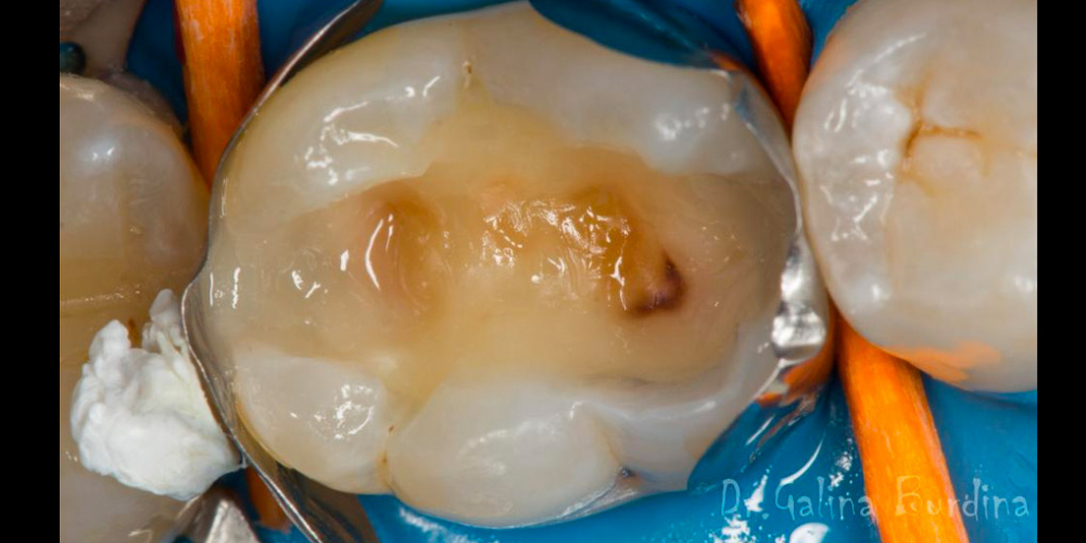Лечение вторичного кариеса под пломбой, реставрация зуба 46, МОД - фото №15