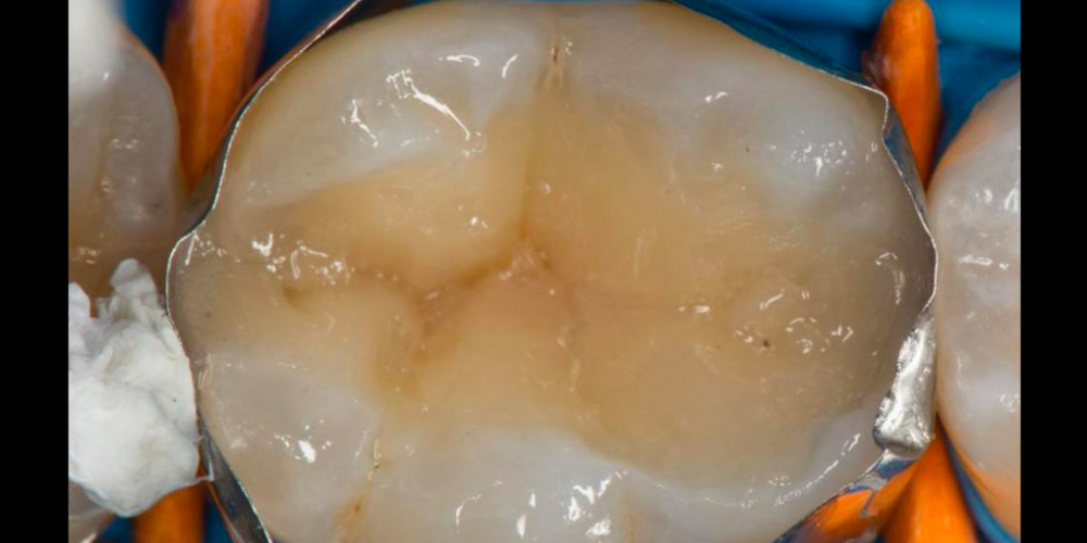 Лечение вторичного кариеса под пломбой, реставрация зуба 46, МОД - фото №16