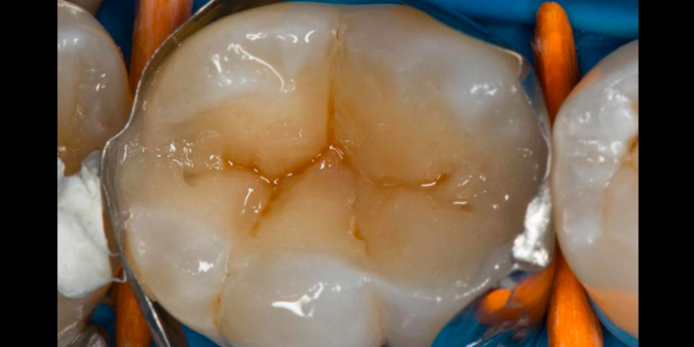 Лечение вторичного кариеса под пломбой, реставрация зуба 46, МОД - фото №17