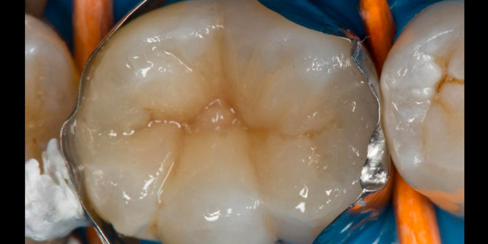 Лечение вторичного кариеса под пломбой, реставрация зуба 46, МОД - фото №18