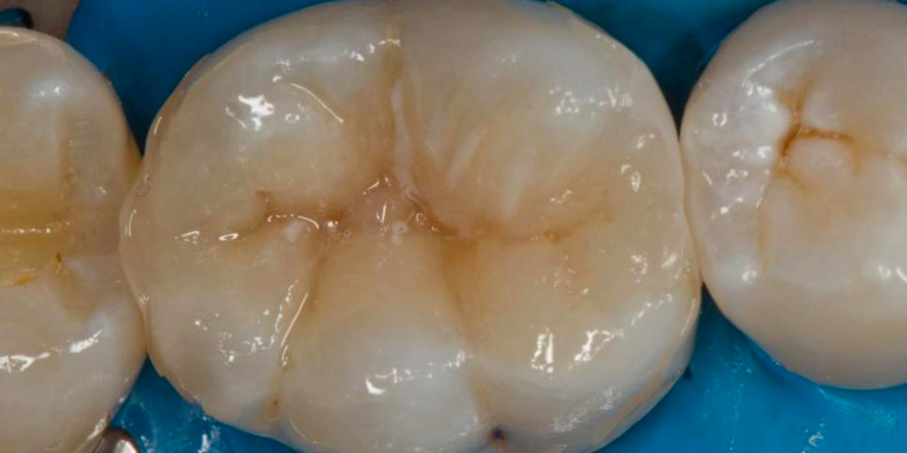 Лечение вторичного кариеса под пломбой, реставрация зуба 46, МОД - фото №19