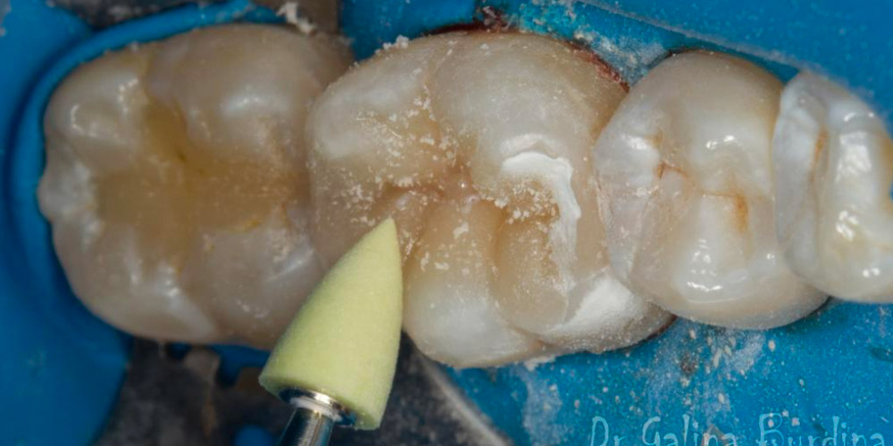 Лечение вторичного кариеса под пломбой, реставрация зуба 46, МОД - фото №20