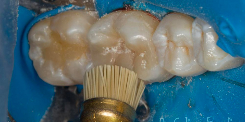 Лечение вторичного кариеса под пломбой, реставрация зуба 46, МОД - фото №21
