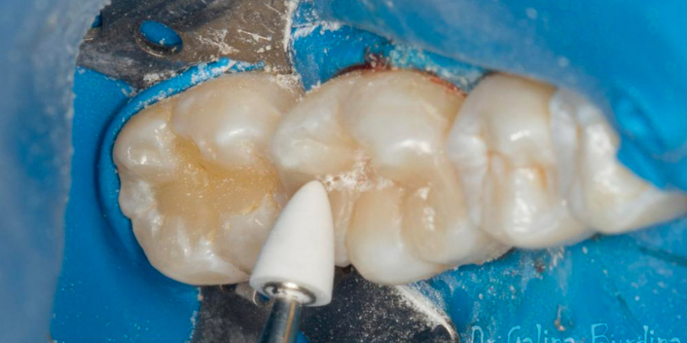 Лечение вторичного кариеса под пломбой, реставрация зуба 46, МОД - фото №2