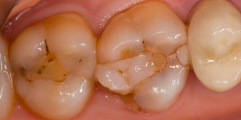 Реставрация жевательных зубов 26 и 27 с армированием - фото №1