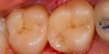 Реставрация жевательных зубов 26 и 27 с армированием - фото №3