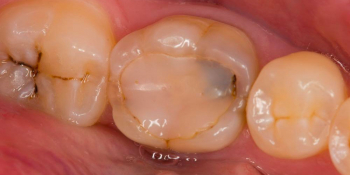 Восстановление зуба после эндодонтического лечения - фото №1
