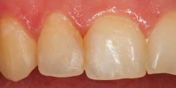 Реставрация зубов 12, 11 по 3 классу и восстановление длины зуба 21 - фото №1