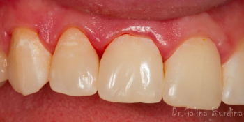 Реставрация зубов 12, 11 по 3 классу и восстановление длины зуба 21 - фото №6