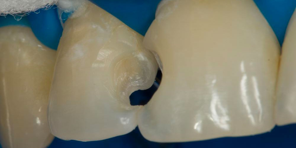 Реставрация зубов 12, 11 по 3 классу и восстановление длины зуба 21 - фото №4