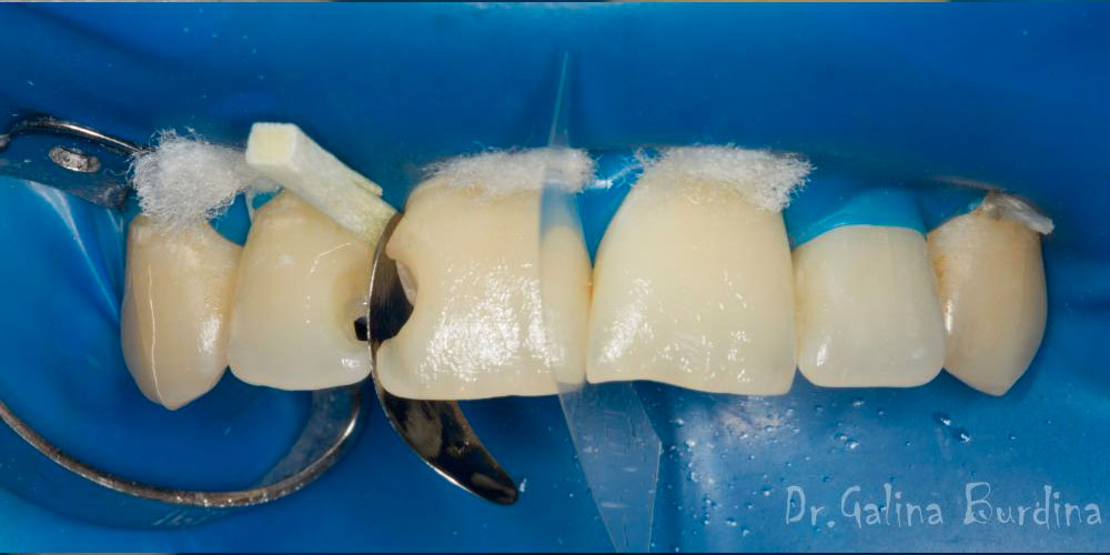 Реставрация зубов 12, 11 по 3 классу и восстановление длины зуба 21 - фото №5