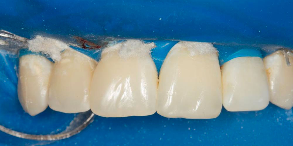 Реставрация зубов 12, 11 по 3 классу и восстановление длины зуба 21 - фото №2