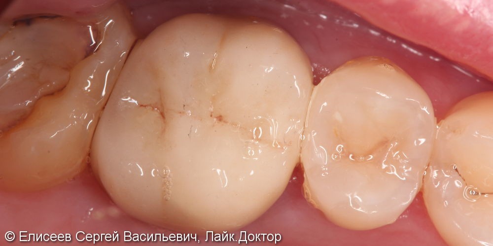 Изготовление металлокерамической коронки 2.6 зуба фото 2 · Воронеж