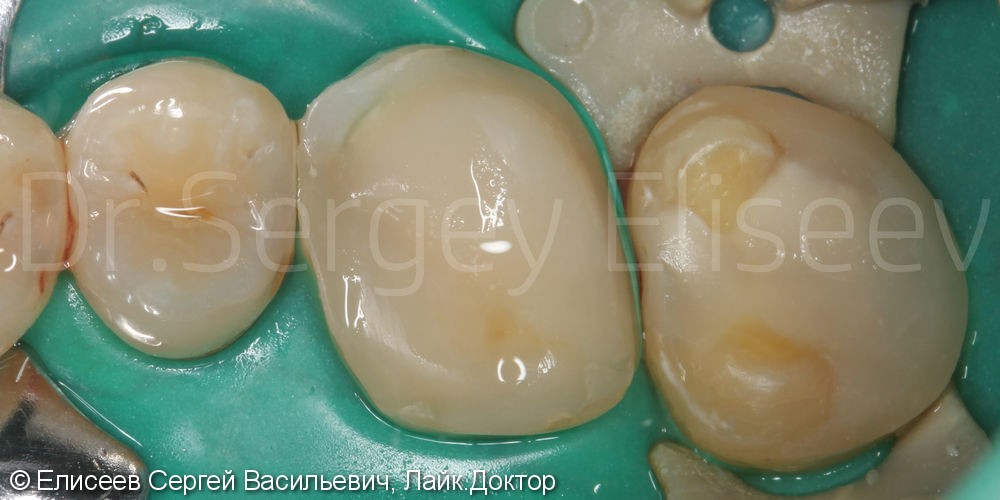 Керамические вкладки 2х жевательных зубов 1.6, 1.7, до и после - фото №2
