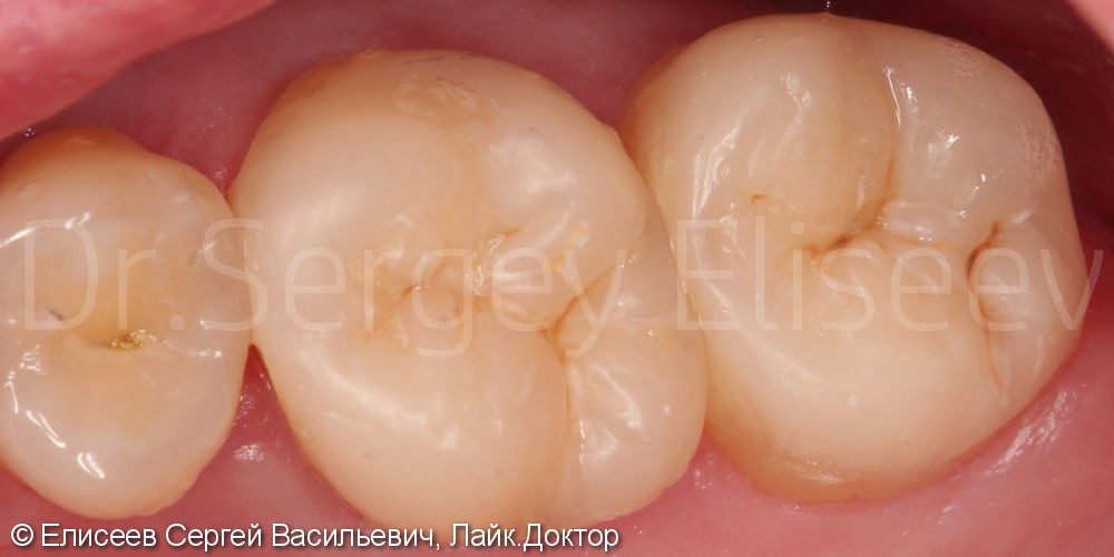 Керамические вкладки 2х жевательных зубов 1.6, 1.7, до и после - фото №3