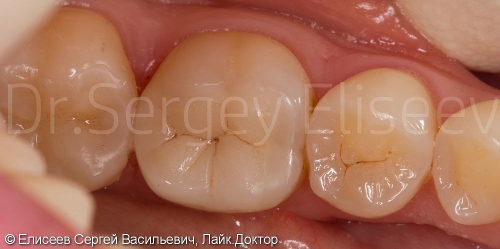 Керамическая вкладка зуба 46 - фото №2