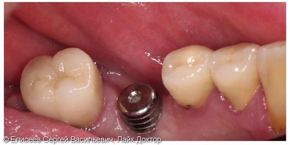 Металлокерамическая коронка зуба 46 с опорой на имплантат - фото №1
