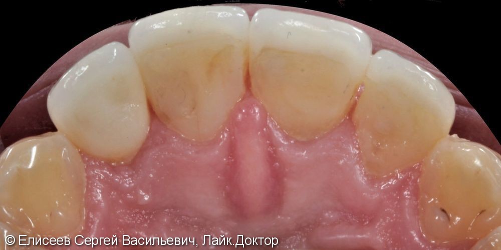3 керамических винира и 1 коронка изготовленные по технологии E.max на 4-х резцах верхней челюсти - фото №6