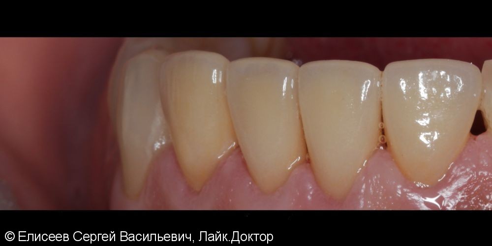 Изготовление четырех цельнокерамических виниров e.max на резцы нижней челюсти - фото №3