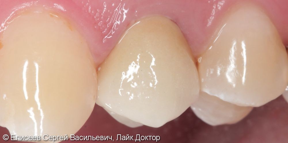 Металлокерамическая коронка зуба 2.4 - фото №3