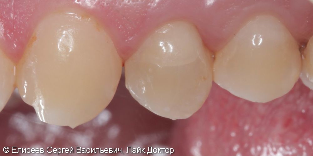 Металлокерамическая коронка зуба 2.4 - фото №1