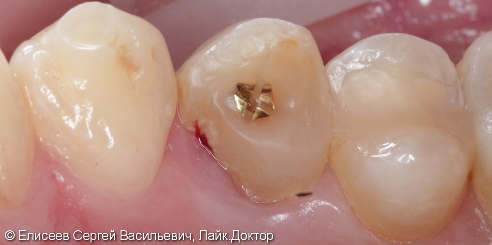 Металлокерамическая коронка зуба 2.4 - фото №2