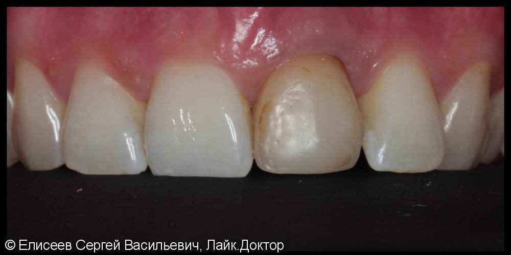 Керамический винир на один передний зуб 2.1, до и после - фото №1
