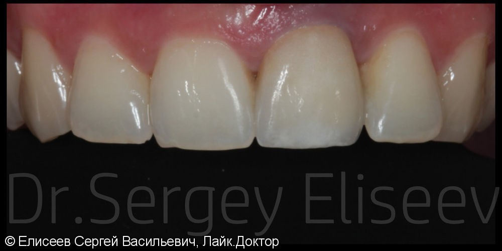 Керамический винир на один передний зуб 2.1, до и после - фото №2