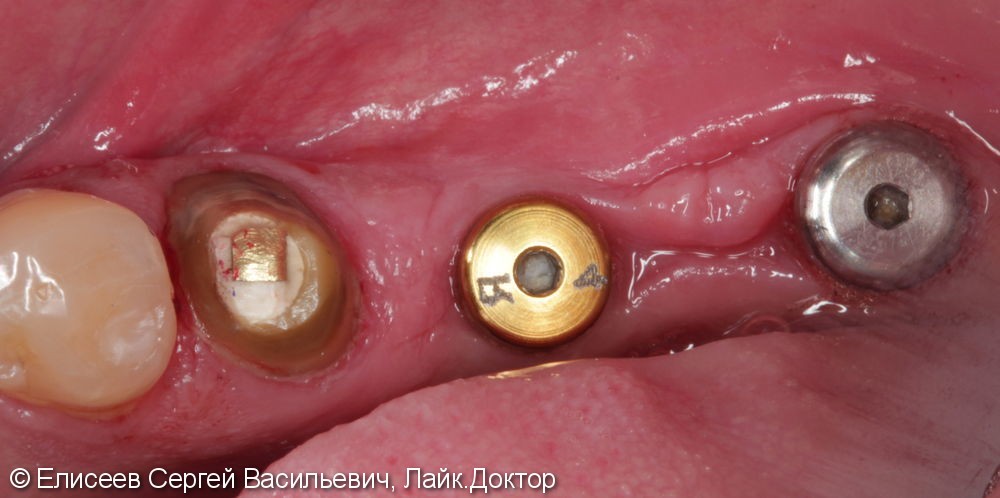 Металлокерамические коронки с опорой на зуб 3.5 и имплантаты в области 3.6,3.7. - фото №1