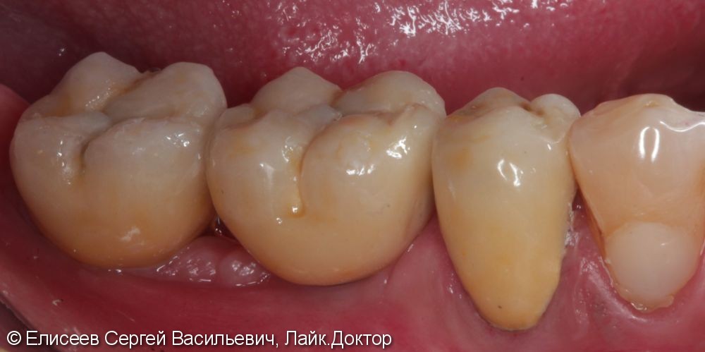 Металлокерамические коронки с опорой на зуб 3.5 и имплантаты в области 3.6,3.7. - фото №2