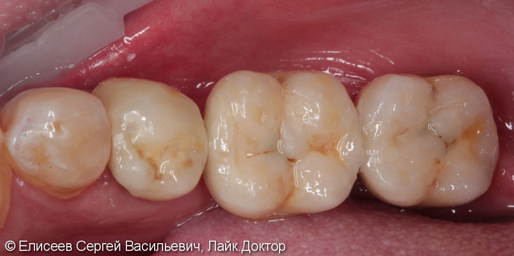 Металлокерамические коронки с опорой на зуб 3.5 и имплантаты в области 3.6,3.7. - фото №3