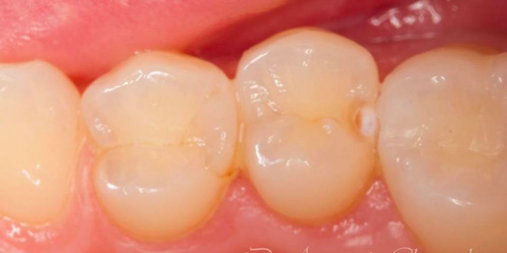 Лечение кариеса трех зубов подряд - фото №1