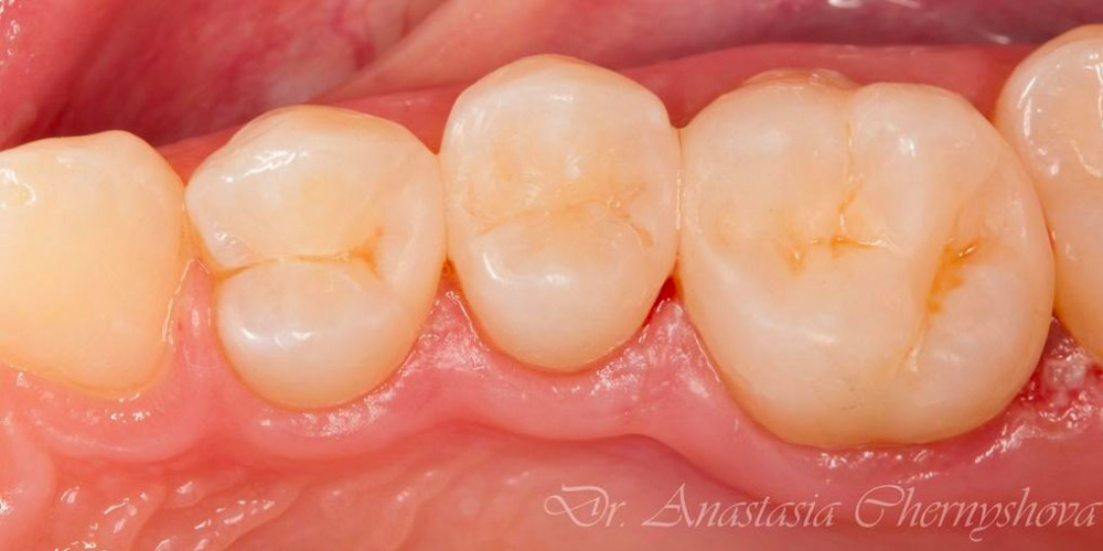 Лечение кариеса трех зубов подряд - фото №5