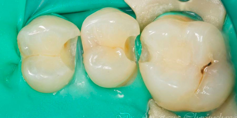 Лечение кариеса трех зубов подряд - фото №3
