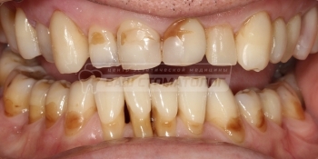 Эстетическая реставрация зубов - фото №1