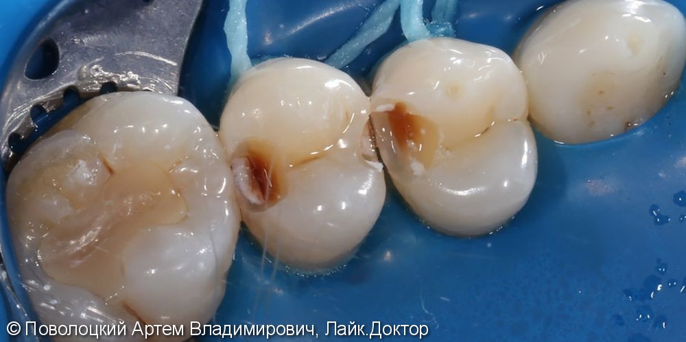 Лечение кариеса жевательных зубов, фото лечения - фото №1