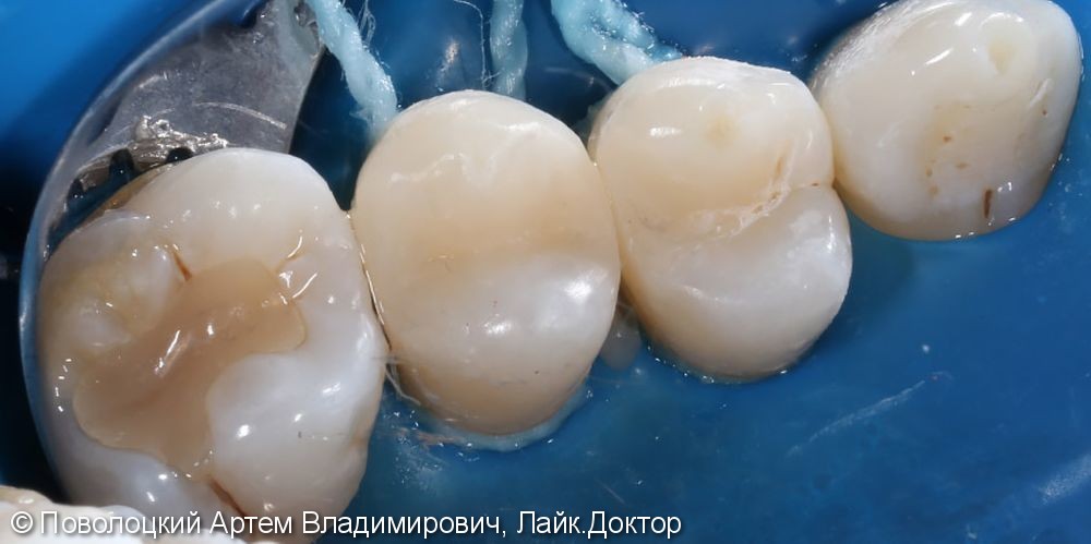 Лечение кариеса жевательных зубов, фото лечения - фото №2
