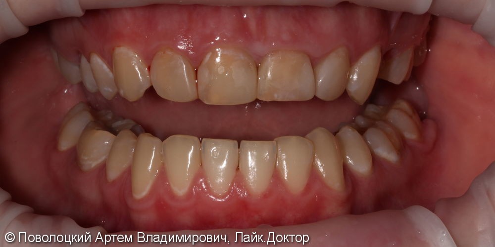 Керамические виниры E-max на переднюю группу зубов верхней челюсти - фото №1