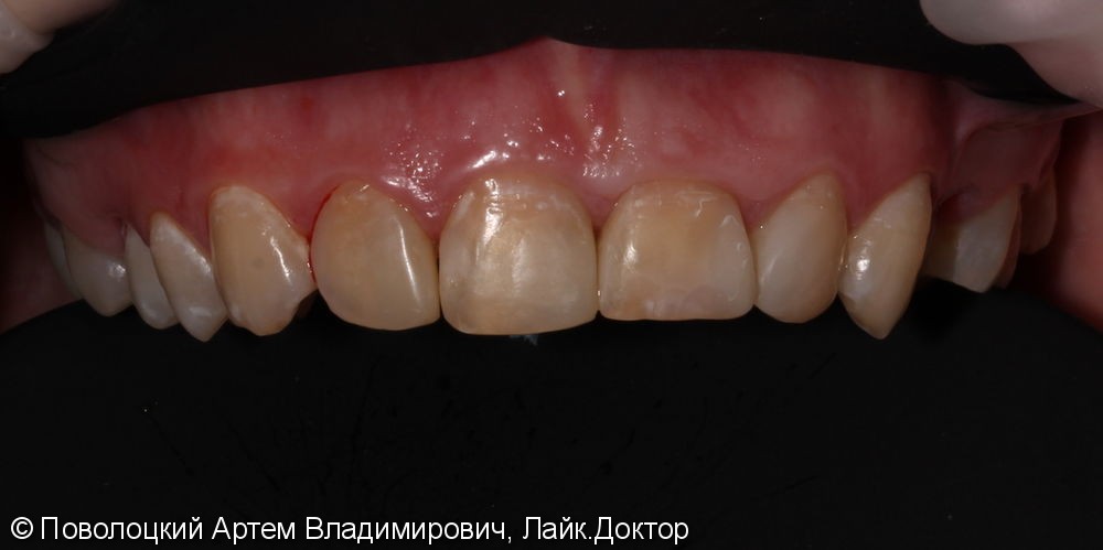 Керамические виниры E-max на переднюю группу зубов верхней челюсти - фото №2