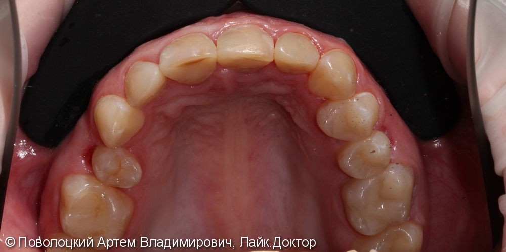 Керамические виниры E-max на переднюю группу зубов верхней челюсти - фото №3