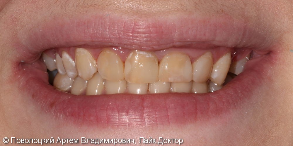 Керамические виниры E-max на переднюю группу зубов верхней челюсти - фото №4