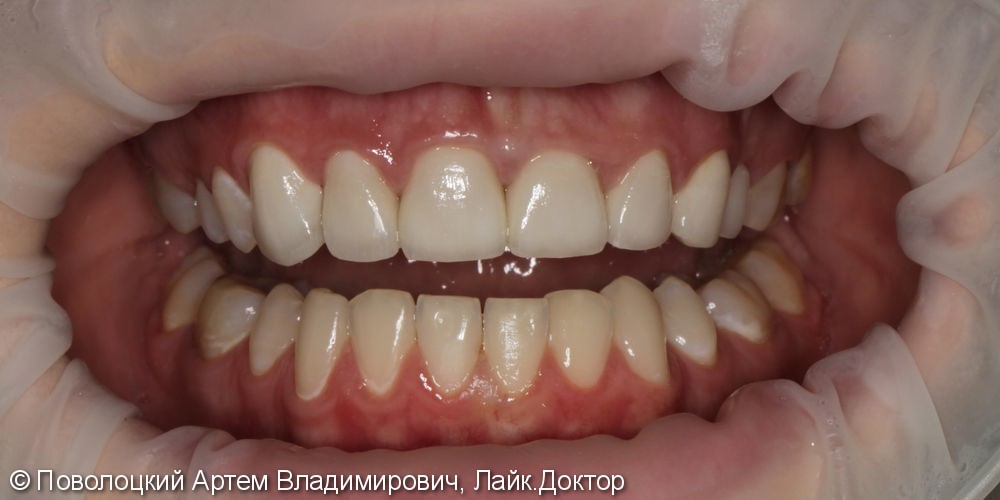 Керамические виниры E-max на переднюю группу зубов верхней челюсти - фото №5